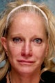 Revising cheek implants and fixing eyelids