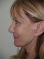 Revision Rhinoplasty