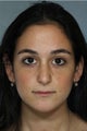 Rhinoplasty