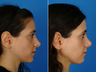Nose Surgery (Revision Rhinoplasty)