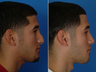 Nose Surgery (Revision Rhinoplasty)