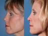 Revision rhinoplasty