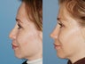 Revision rhinoplasty
