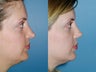 Revision rhinoplasty