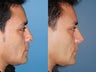 Revision rhinoplasty