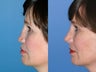 Revision rhinoplasty