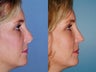 Revision rhinoplasty