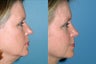 Revision rhinoplasty