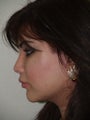 Revision Rhinoplasty
