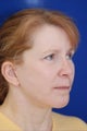 Facelift and Revision Rhinoplasty
