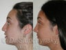 Rhinoplasty (Nose Job)