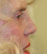 Revision rhinoplasty