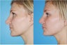 Rhinoplasty