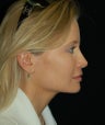 Revision Rhinoplasty