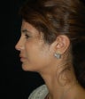 Revision Rhinoplasty