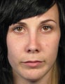 Revision Rhinoplasty