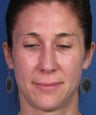 Revision Rhinoplasty
