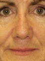 Revision Rhinoplasty