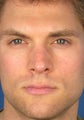Revision Rhinoplasty