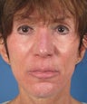 Revision Rhinoplasty