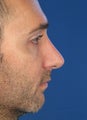 Revision Rhinoplasty