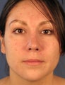 Revision Rhinoplasty