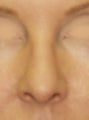 Revision Rhinoplasty