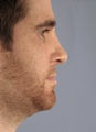 Revision Rhinoplasty