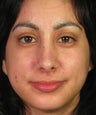 Revision Rhinoplasty