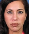 Revision Rhinoplasty
