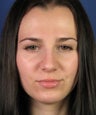 Revision Rhinoplasty