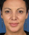 Revision Rhinoplasty