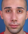 Revision Rhinoplasty