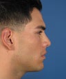 Revision Rhinoplasty