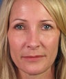 Revision Rhinoplasty