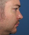 Revision Rhinoplasty