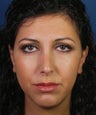 Revision Rhinoplasty