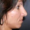 Revision Rhinoplasty