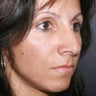 Revision Rhinoplasty