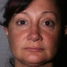 Revision Rhinoplasty