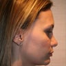 Revision Rhinoplasty