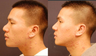 Revision Asian Rhinoplasty