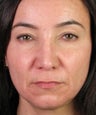 Revision Rhinoplasty