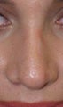 Revision Rhinoplasty