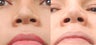 Revision Rhinoplasty