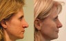 Open revision Rhinoplasty with auricular grafting