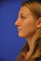 Revision Rhinoplasty