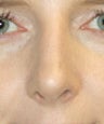 Revision Rhinoplasty