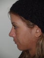Revision Rhinoplasty