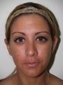 Revision Rhinoplasty